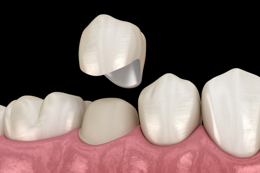 Dental Crown Placement: Front Vs  Back Teeth