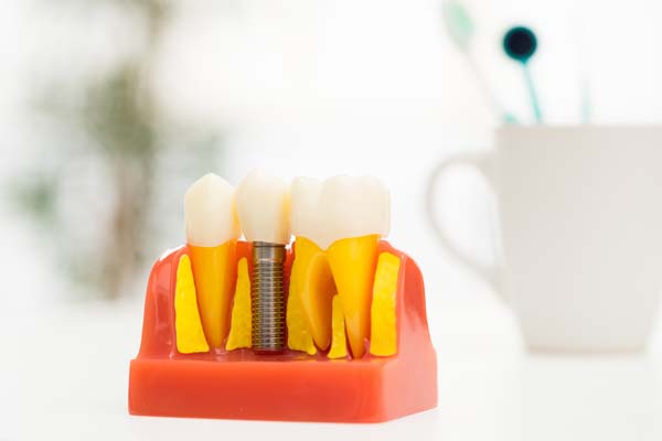 Aftercare Tips For Implant Crowns