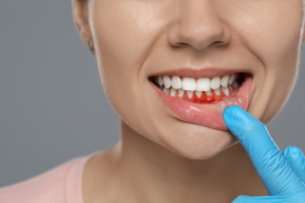 Preventing Periodontal Disease: Signs Of Healthy Gums